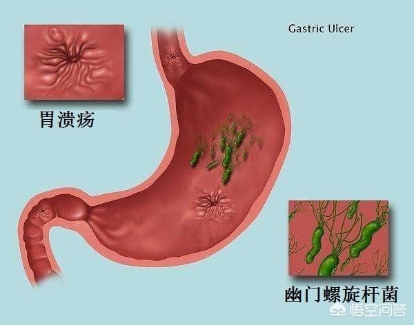 胃癌胃窦_胃体胃窦癌_胃癌胃窦部