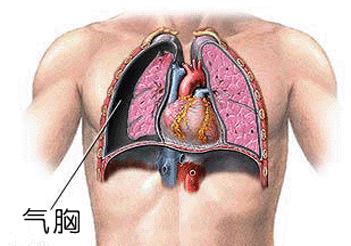 胸膜腔临床意义_胸腔3d模型_医学3d动画胸膜腔