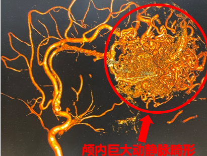 脑血管瘤介入治疗弹簧圈_脑血管介入手术弹簧圈费用_颅内血管瘤介入弹簧圈