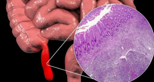 阑尾：这个退化器官为何总给人带来大麻烦？